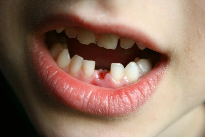 Góc giải đáp thắc mắc: Thiếu răng có niềng được không? 1