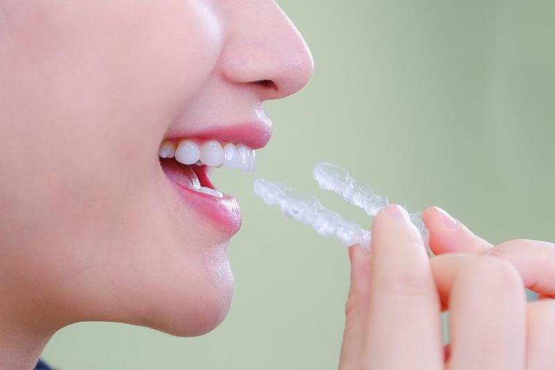 Góc giải đáp thắc mắc: Thiếu răng có niềng được không? 2