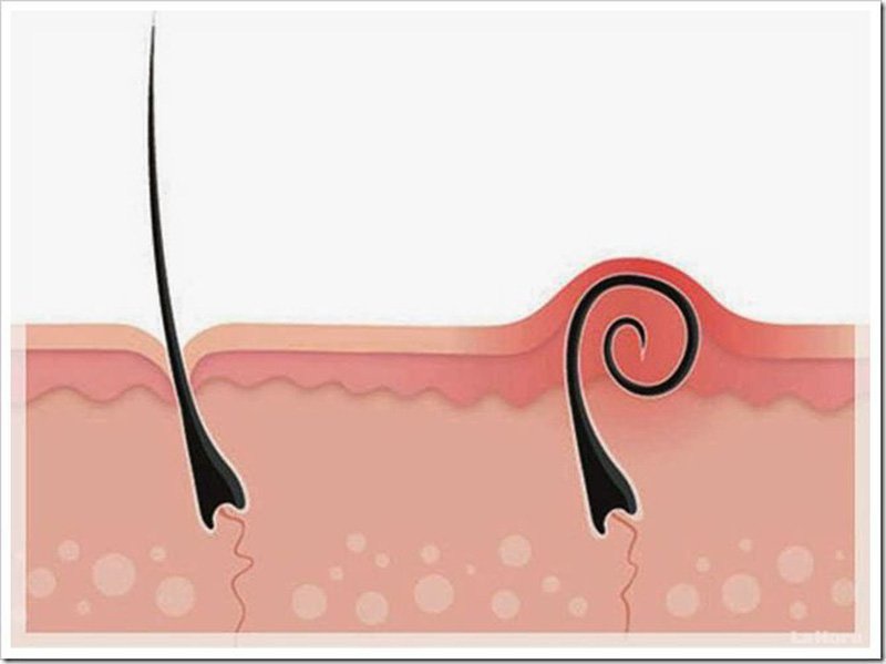 Góc làm đẹp: Cách wax lông không bị mọc ngược1