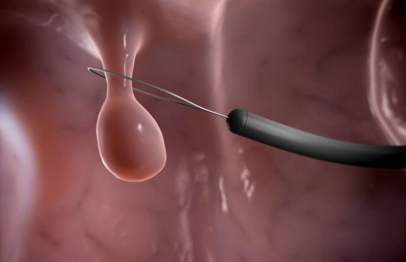 Đốt polyp cổ tử cung có đau không là nỗi lo lắng của nhiều người