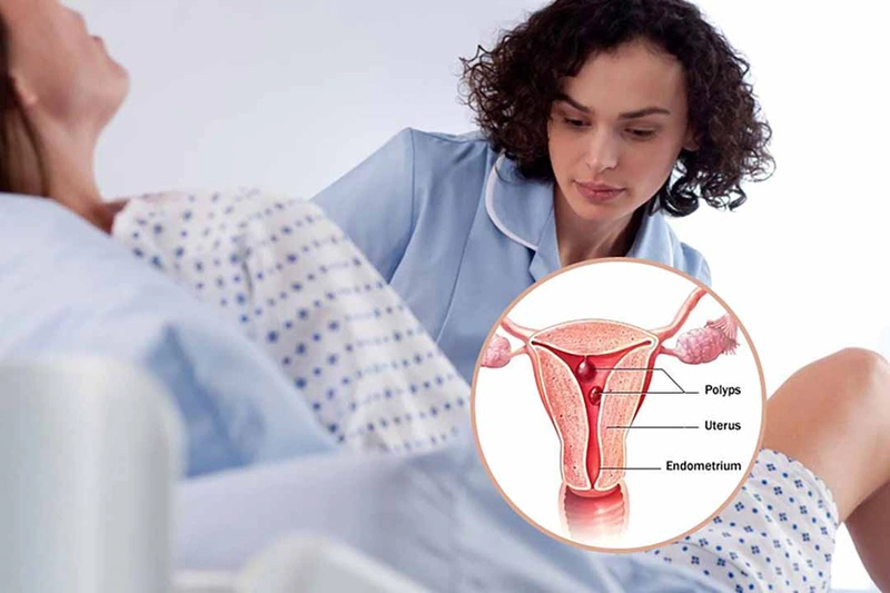 Lưu ý sau khi đốt polyp cổ tử cung