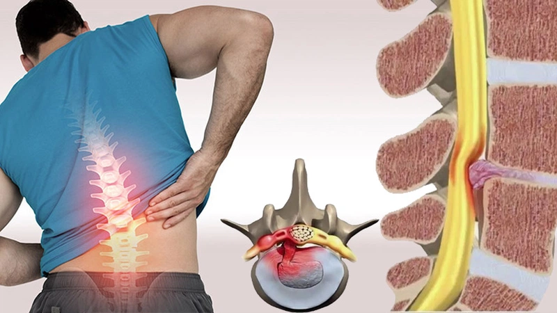 bị thoát vị đĩa đệm có quan hệ được không