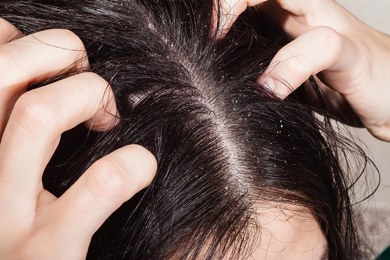 Gội bồ kết vẫn bị rụng tóc? Lý do thật đơn giản, ít người biết 2