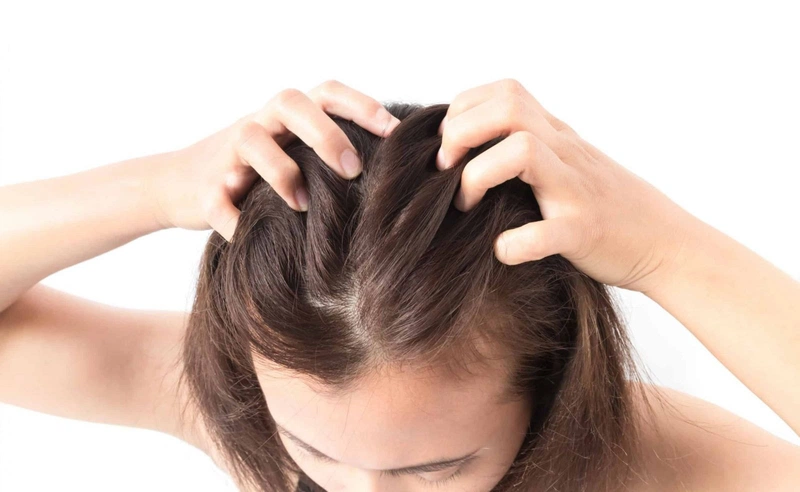 Gợi ý những cách trị chấy hiệu quả ngay tại nhà 1