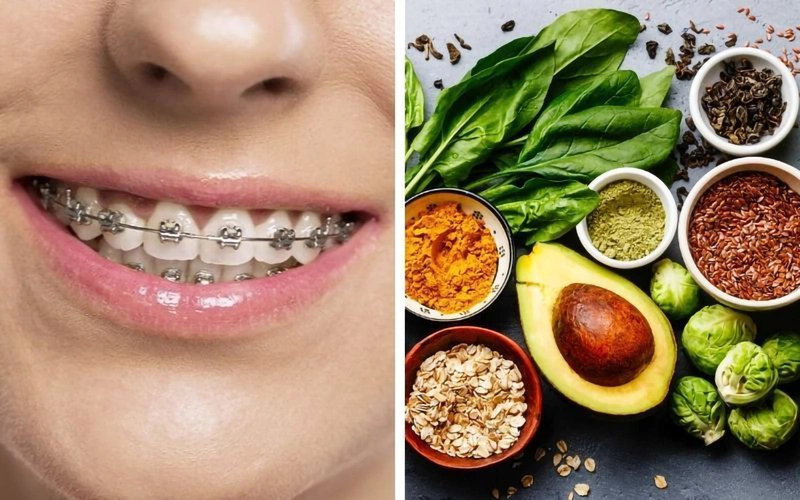 Niềng răng nên ăn gì hay không nên ăn gì là thắc mắc của rất nhiều người trong quá trình nắn chỉnh răng về đúng vị trí trên cung hàm