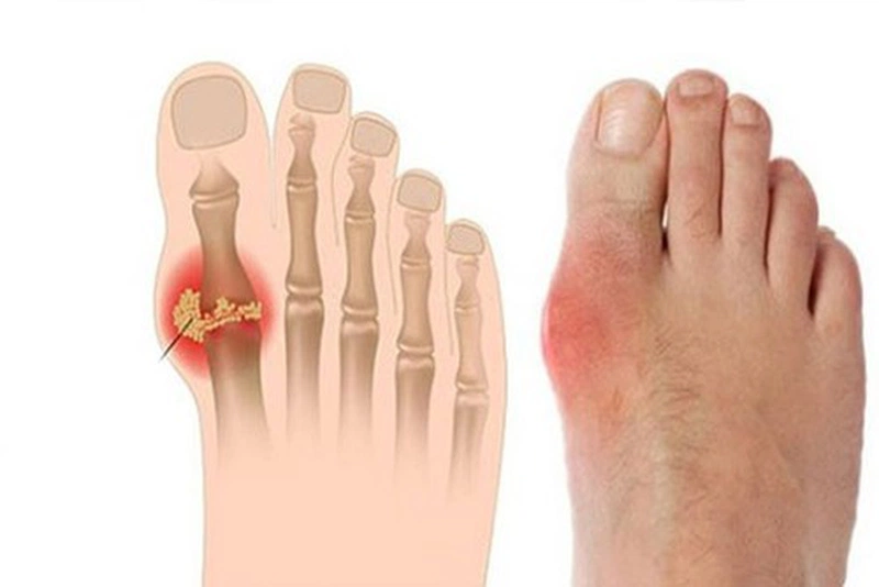 Khám bệnh gout ở đâu Hà Nội?1