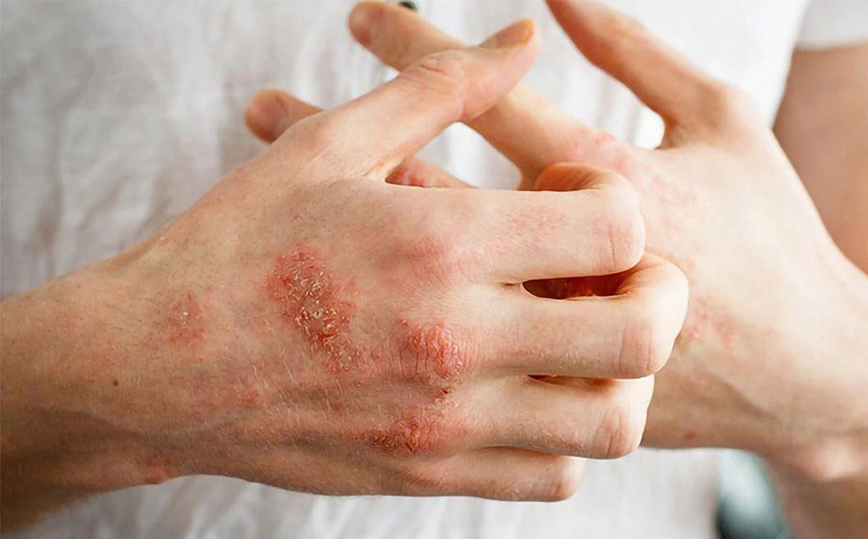 Bệnh hắc lào bị chàm hoá xảy ra khi da người bệnh có dấu hiệu sần sùi, rỉ dịch gây ngứa ngáy khó chịu
