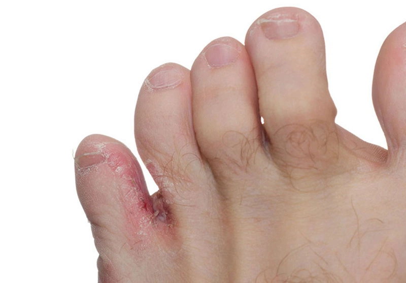 Bị hắc lào nổi mụn nước ở các kẽ ngón chân