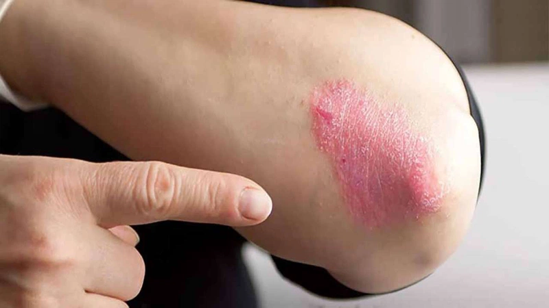 Người bị bệnh hắc lào có mụn nước thường xuyên xuất hiện cảm giác ngứa