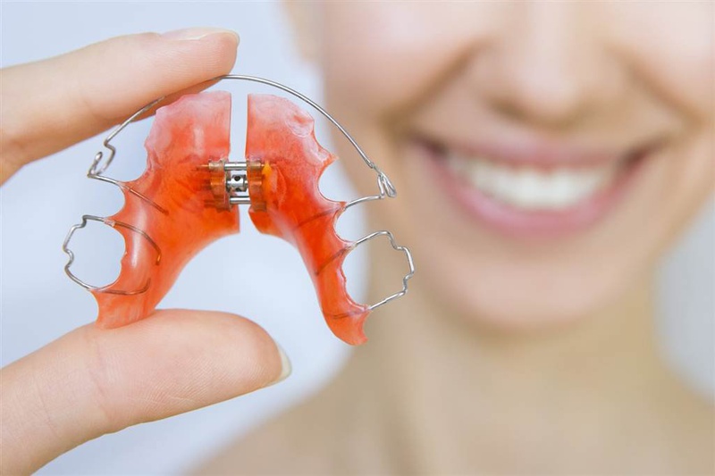 Hàm duy trì là gì và cần đeo bao lâu sau khi tháo niềng 1