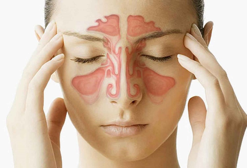 Hậu quả của bệnh viêm mũi dị ứng khi điều trị không đúng cách 1