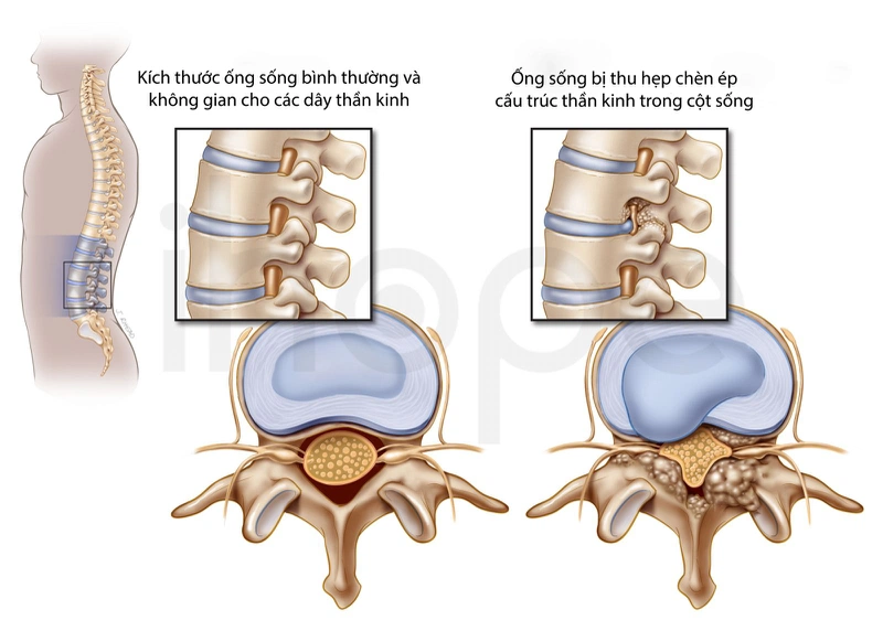 Hẹp ống sống có nguy hiểm không? Nguyên nhân, triệu chứng, chẩn đoán và điều trị 1