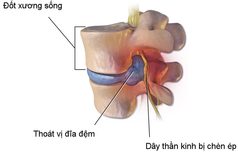 Hẹp ống sống có nguy hiểm không? Nguyên nhân, triệu chứng, chẩn đoán và điều trị 2