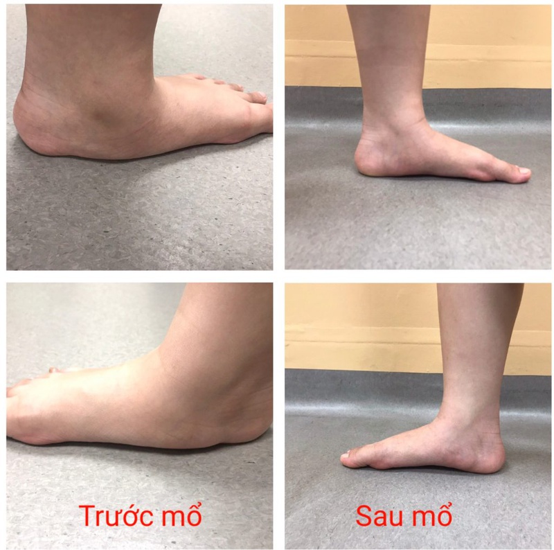 Hiện tượng bàn chân bẹt có biểu hiện gì? Phương pháp điều trị bàn chân bẹt ở trẻ em 4