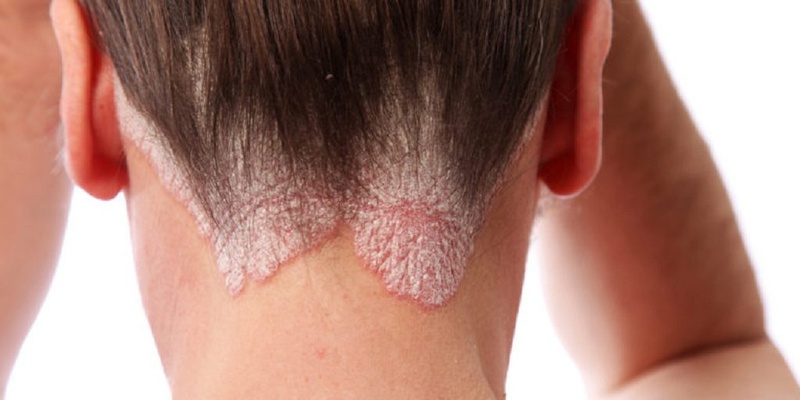 Tổng hợp những hiện tượng bệnh vảy nến cần biết 1