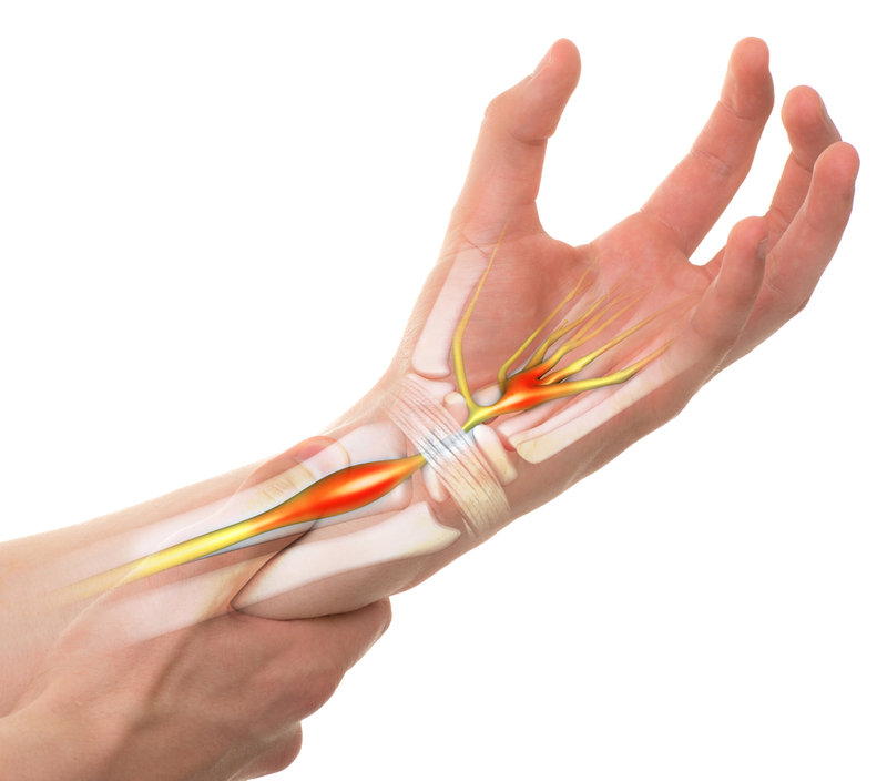 Hiện tượng bong gân cổ tay là chấn thương khi xây chằng bao bọc xung quanh khớp cổ tay bị giãn quá mức và có thể bị rách