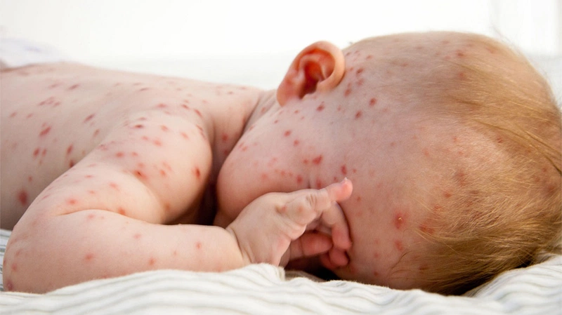 Hiện tượng lên sởi ở trẻ em rất nguy hiểm mà bố mẹ không thể bỏ qua 1