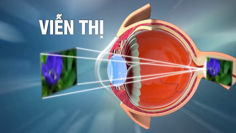 Hiểu đúng về viễn thị để có cách chữa trị và phòng ngừa tốt nhất 1