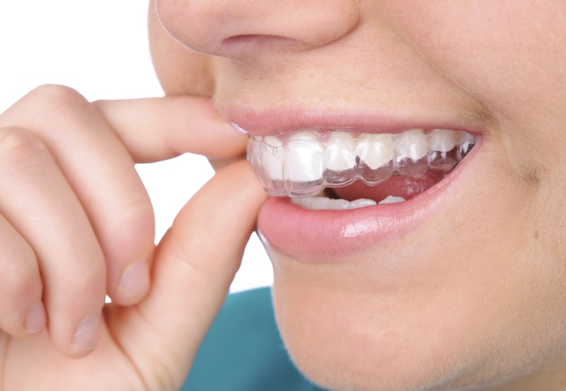 Tẩy răng bằng máng có thể thể thực hiện tại nhà