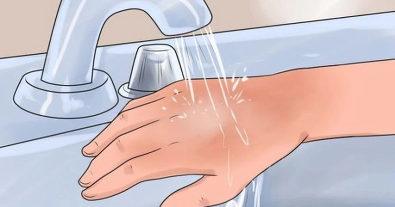Cách sơ cứu hiệu quả khi bị bỏng hơi nước 3