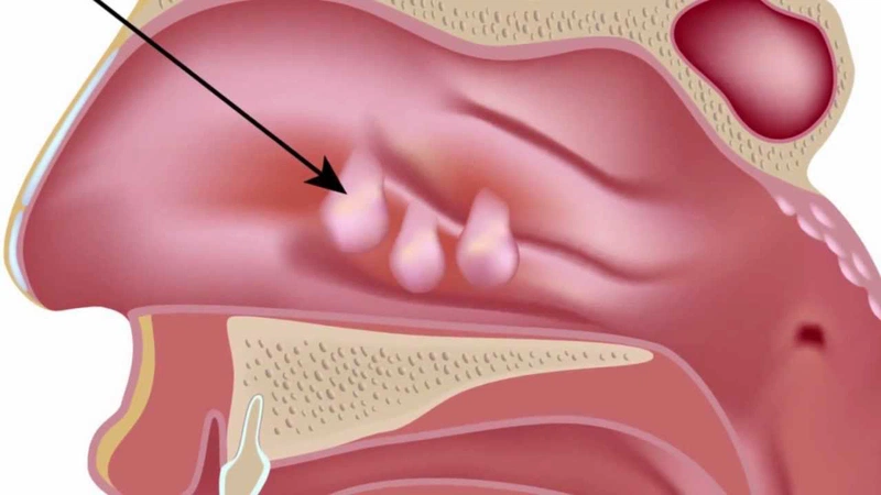 Hình ảnh polyp mũi và những triệu chứng của bệnh 1