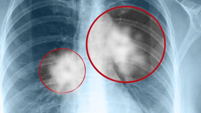 Hình ảnh ung thư phổi trên phim X-quang có ý nghĩa gì? - Nhà thuốc ...