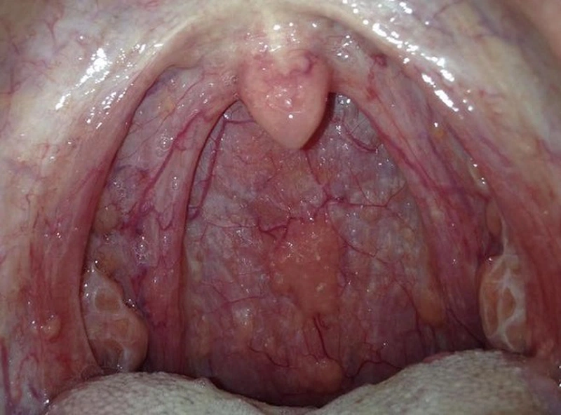 Hình ảnh đầy đủ nhất về bệnh ung thư vòm họng  Anticanvn