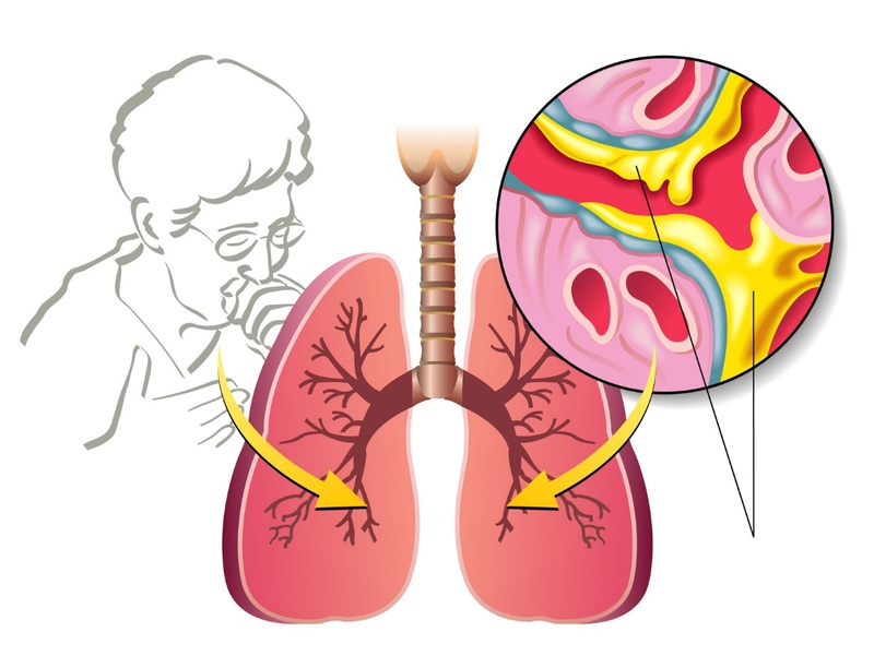 Ho có đờm xanh là dấu hiệu của bệnh hô hấp nguy hiểm?1