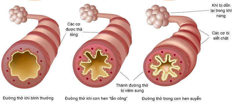 Ho tức ngực khó thở là bệnh gì? Những lưu ý khi gặp triệu chứng này 1