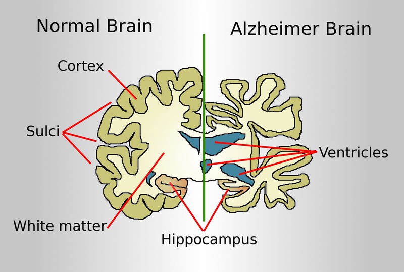 Hội chứng Alzheimer: Nguyên nhân, dấu hiệu nhận biết, phòng ngừa và điều trị 1