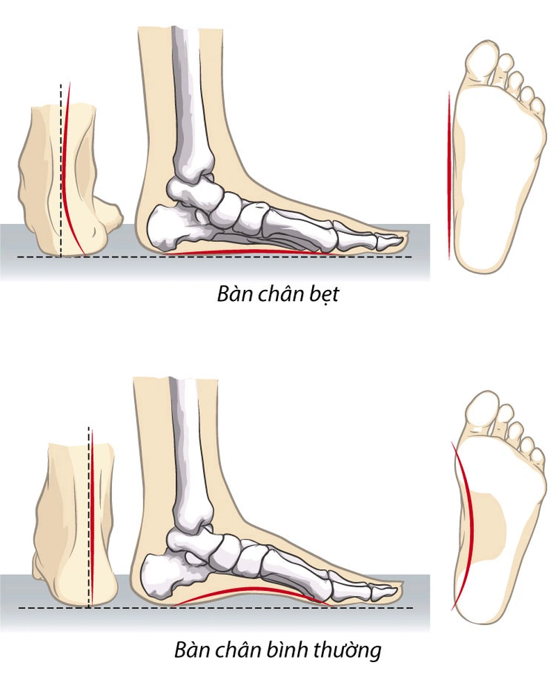 Bàn chân bẹt là gì? Cách chữa bàn chân bẹt ở người lớn 3