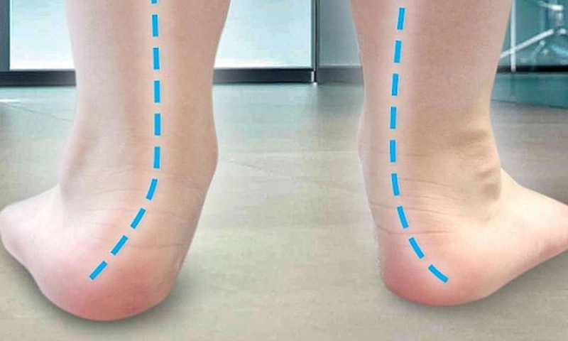 Hội chứng bàn chân bẹt là lòng bàn chân bằng phẳng, không hề lõm xuống