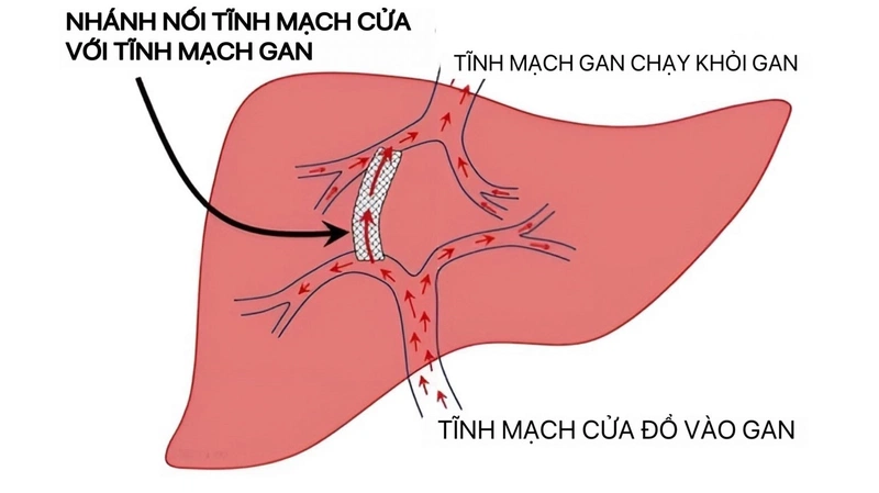 Hội chứng Budd Chiari: Nguyên nhân, triệu chứng và các phương pháp điều trị