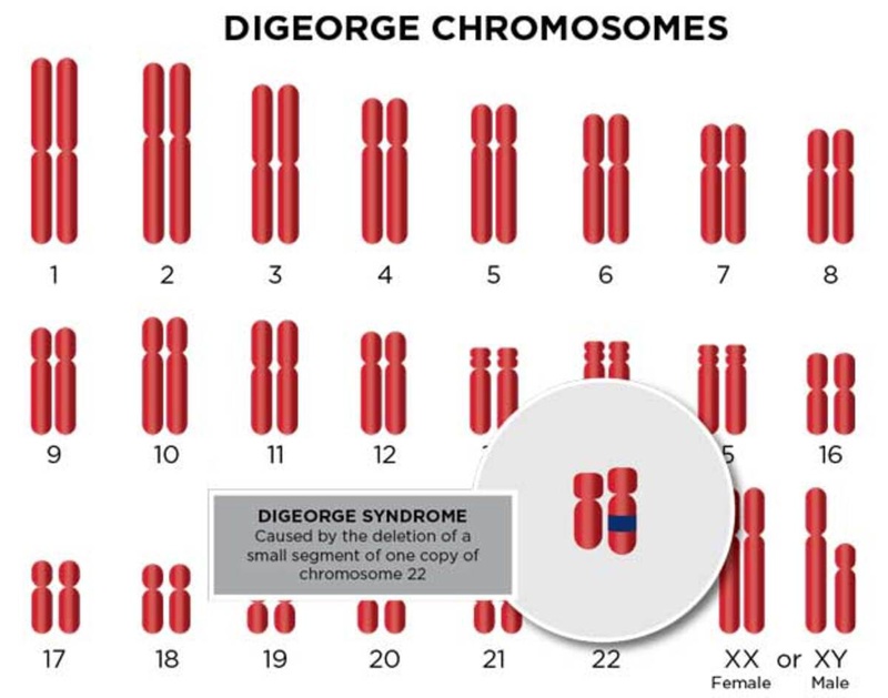 Hội chứng DiGeorge và những điều liên quan có thể bạn chưa biết 1
