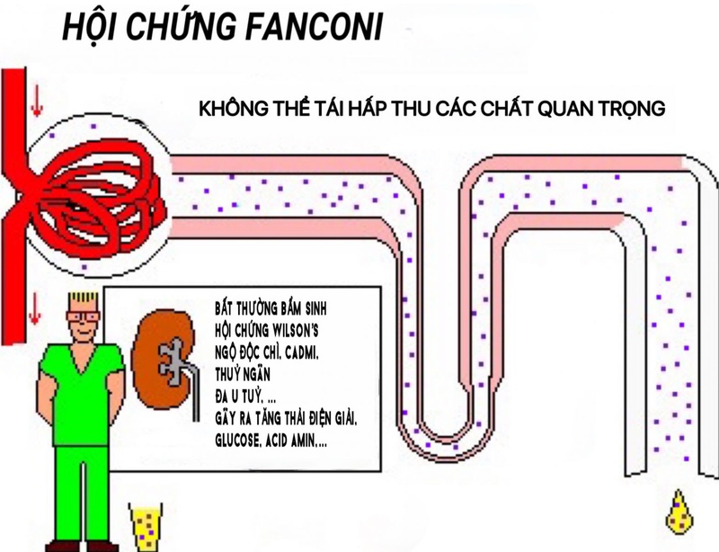 Hội chứng Fanconi là gì? Triệu chứng và điều trị hội chứng Fanconi như thế nào? 1