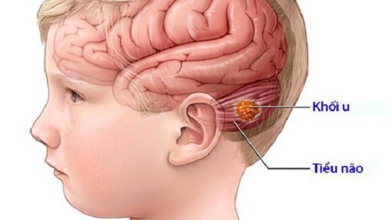 Hội chứng hố sau là gì và cách chăm sóc trẻ em mắc hội chứng hố sau1