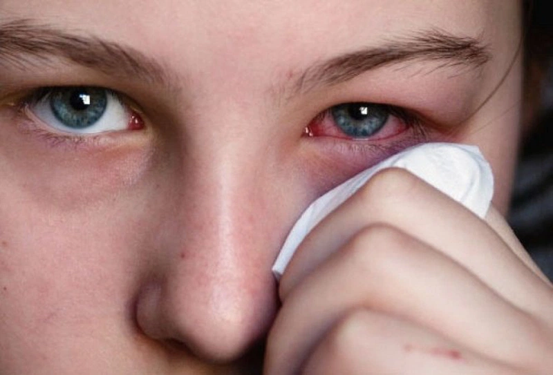 Hội chứng khô mắt và viêm kết mạc dị ứng 3