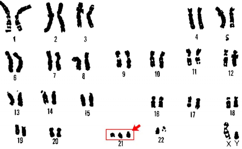 Hội chứng không nhạy cảm androgen là gì 1