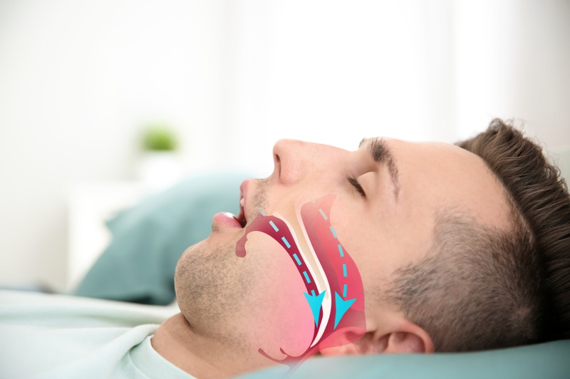 Hội chứng ngưng thở khi ngủ là gì?