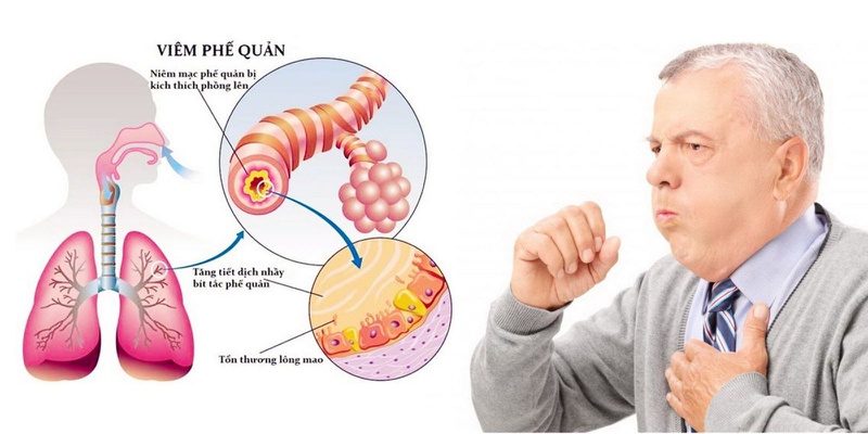 Hội chứng suy hô hấp cấp tính - ARDS là gì? 3