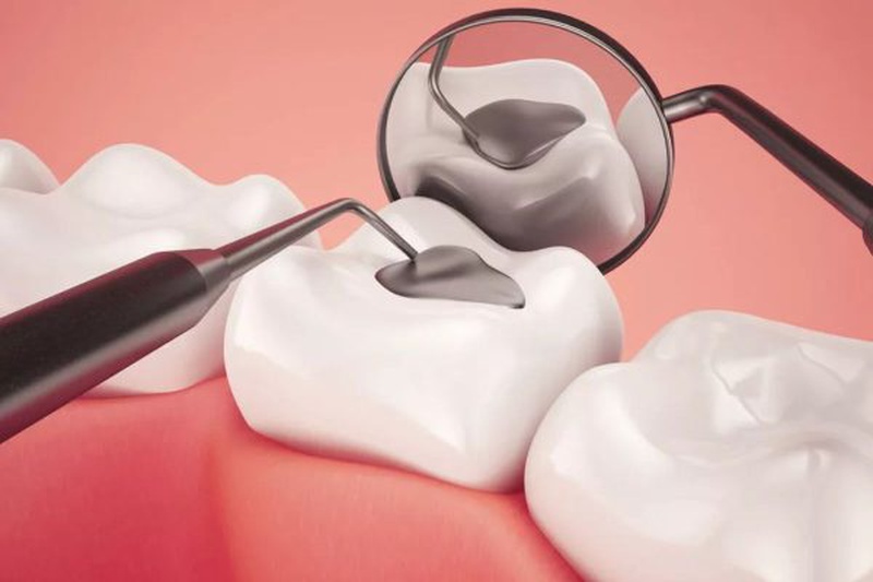 Hàn răng giúp đóng các lỗ sâu răng, thu hẹp vùng răng bị tổn thương