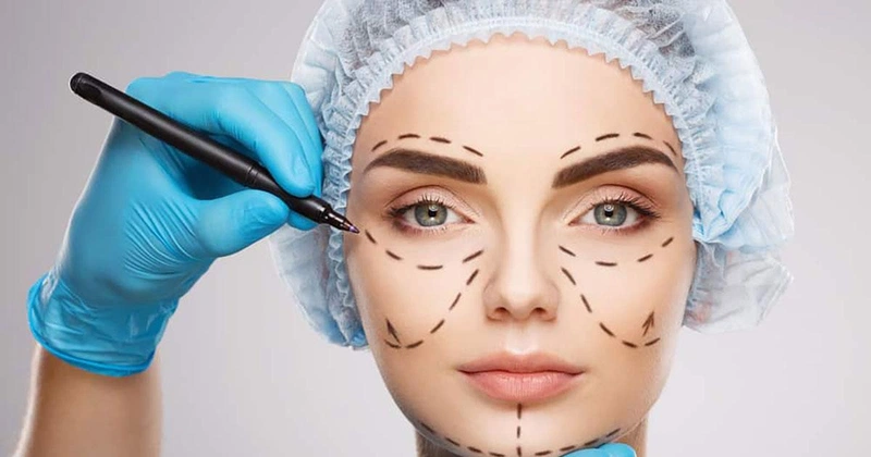 Hỏi đáp làm đẹp: Cắt mí bao lâu thì hết sẹo?2