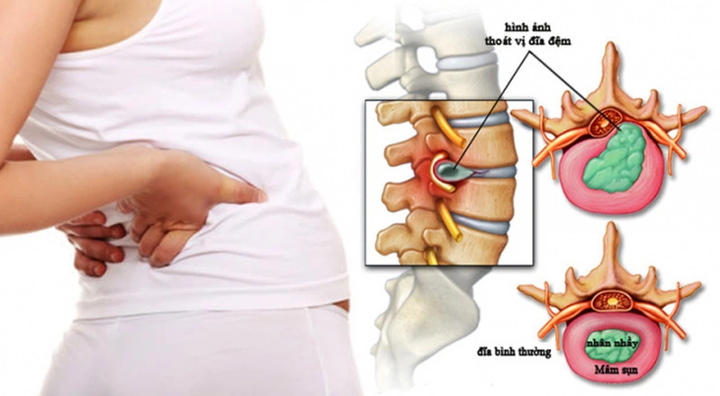 Thoát vị đĩa đệm có thể xảy ra ở bất kỳ vị trí nào của cột sống