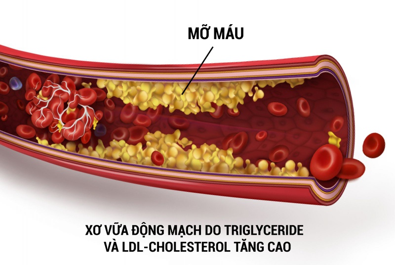 Hướng dẫn cách đọc chỉ số mỡ máu chính xác nhất2