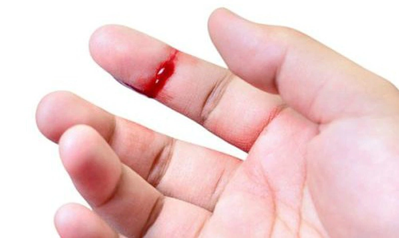 Hướng dẫn cách sơ cứu cầm máu khi bị đứt tay - Nhà thuốc FPT Long Châu