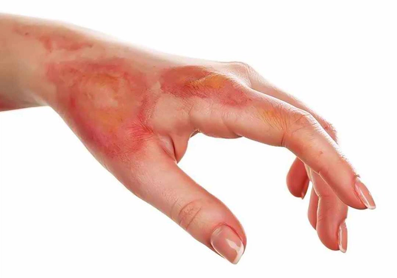 Các biện pháp sơ cứu kịp thời khi bị bỏng axit H2SO4 giúp giảm đau và giảm các di chứng có thể xảy ra