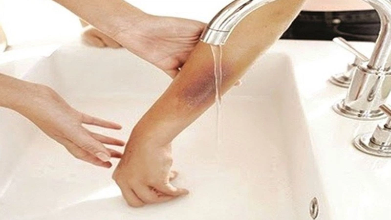 Rửa sạch vết thương bằng cách nhúng nhanh vùng da bị bỏng vào nước nguội sạch để tránh nhiễm trùng