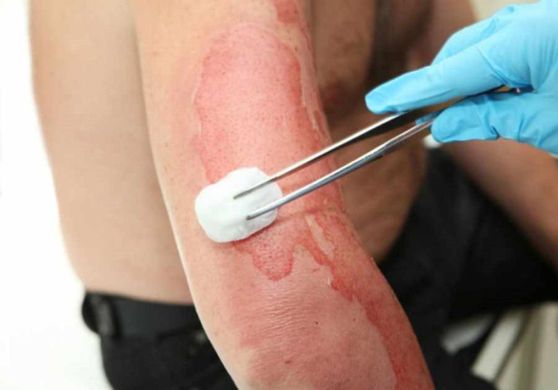 Điều trị đúng cách ngay sau khi bị bỏng xăng sẽ giúp giảm diện tích và độ sâu của vết bỏng, giúp bệnh tiến triển nhẹ hơn