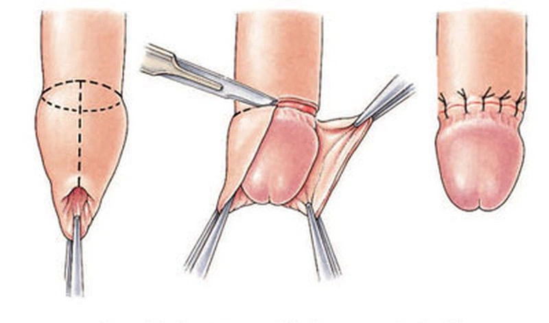 cách thay băng sau khi cắt bao quy đầu tránh viêm nhiễm sau phẫu thuật