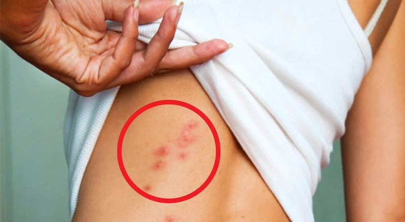 ãy đi khám bác sĩ nếu bạn bị rệp cắn ở nhiều vị trí